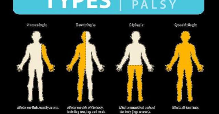 Comprehensive Guide to Cerebral Palsy Stem Cell Treatment India: Hope and Healing